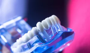 Co to są implanty zębów